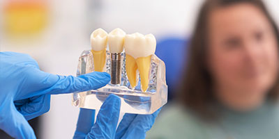Dental Implant